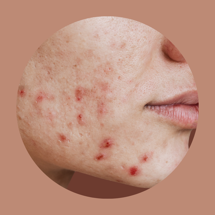 ACNE